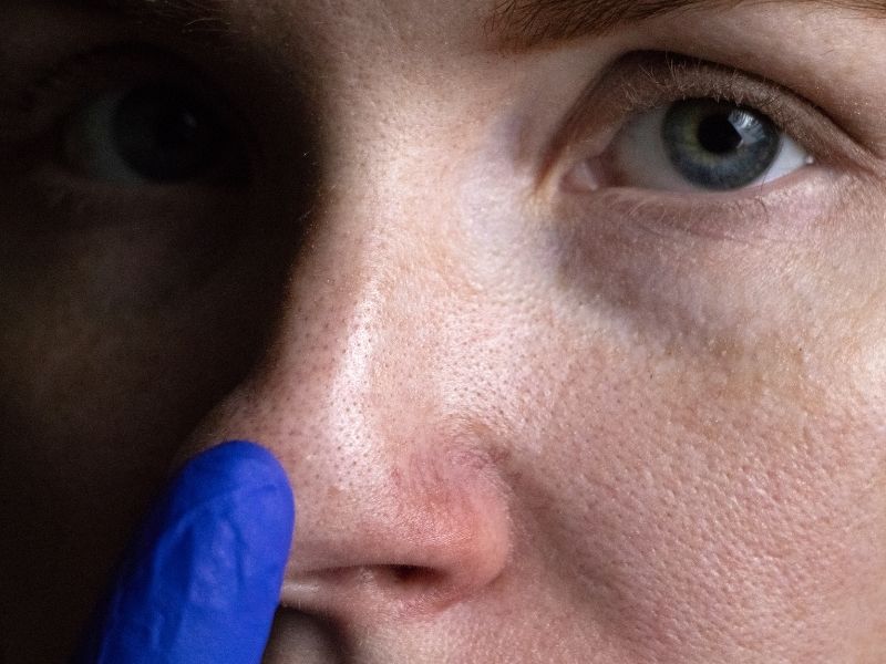 ankarada-burun-estetigi